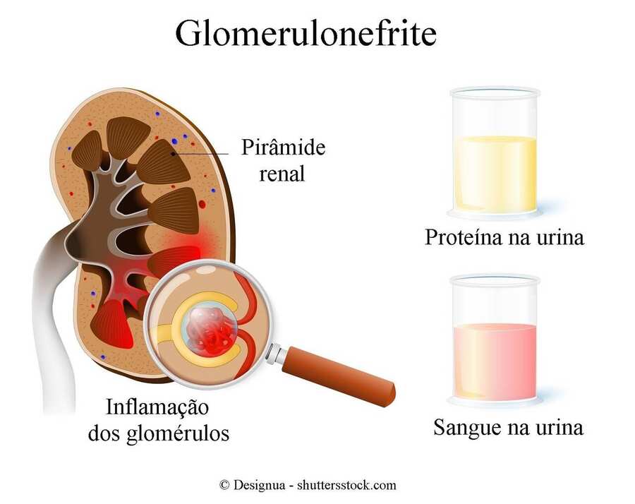  Glomerulonefrite você sabe o que é? Fique atento!